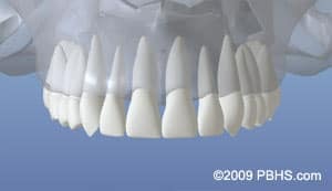 Digital dental model showing full set of white tooth restorations or implants against blue background.