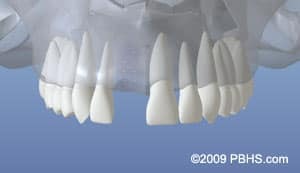 Dental implant crowns arranged in two rows against blue background showing tooth restoration options.