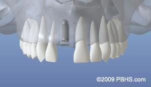 Dental implant models showing upper and lower teeth arrangements against blue background.