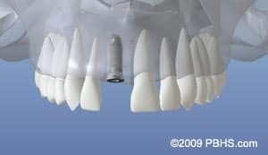 Dental implant model showing teeth arrangement around central implant fixture on blue background.