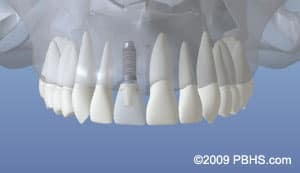 Dental implants model showing full arch tooth replacements against blue background.