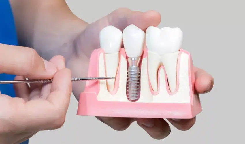 Featured image for “Why Dental Implants Are The Best Option?”