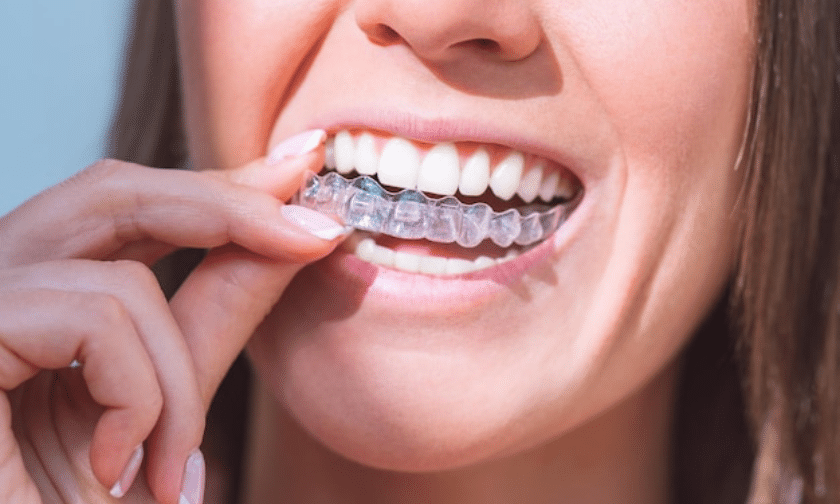Invisalign