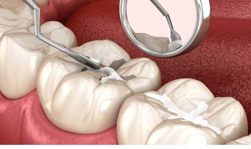 Dental Sealants-Treatment Paradise-Valley