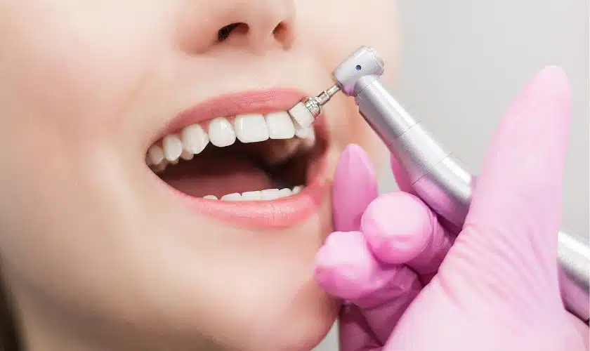 Teeth Whitening