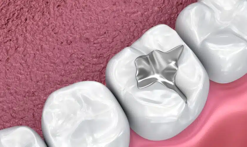 Featured image for “How Dental Sealants Protect Against Tooth Decay?”