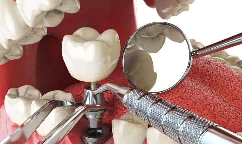 Right Dentist for Implant-Supported Overdentures