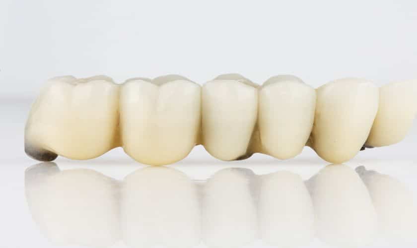 Featured image for “A Comprehensive Guide to How Dental Bridges Work”