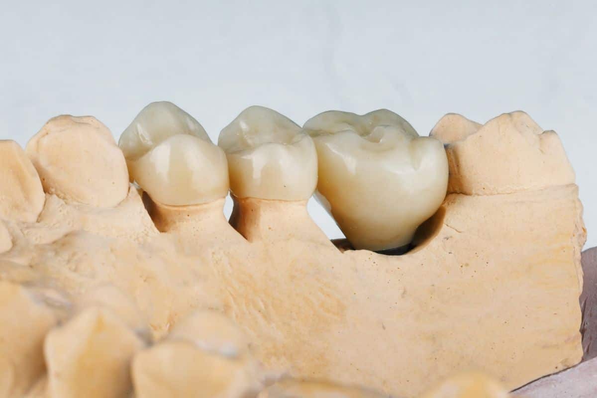 impact of dental crowns