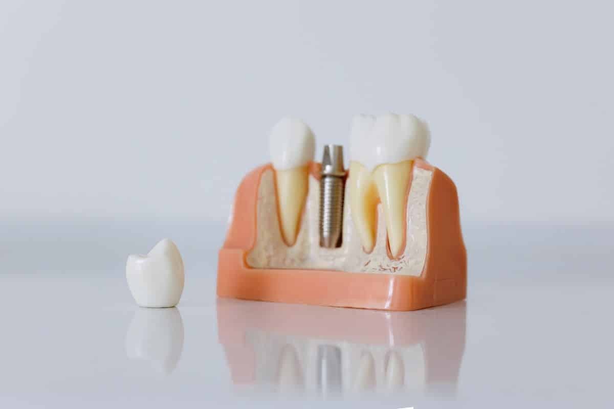 Dental implant model showing titanium posts and crown components on orange base against white background.