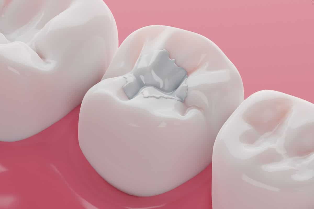 what happens during a dental filling
