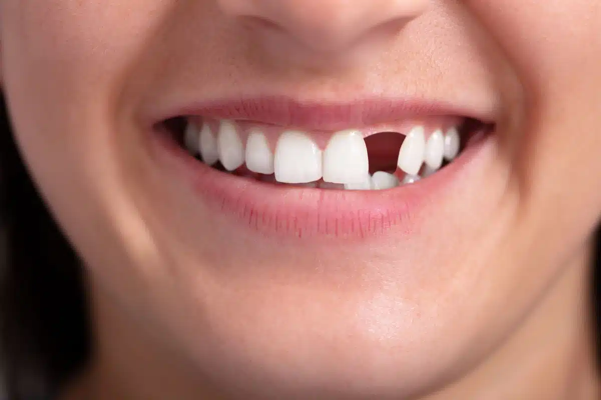 How Missing Upper Teeth Impact Eating and Speaking