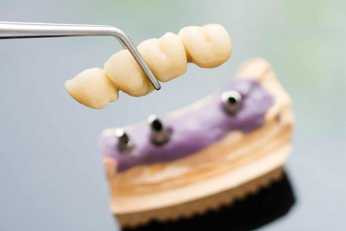 How Dental Bridges Help Prevent Teeth Shifting