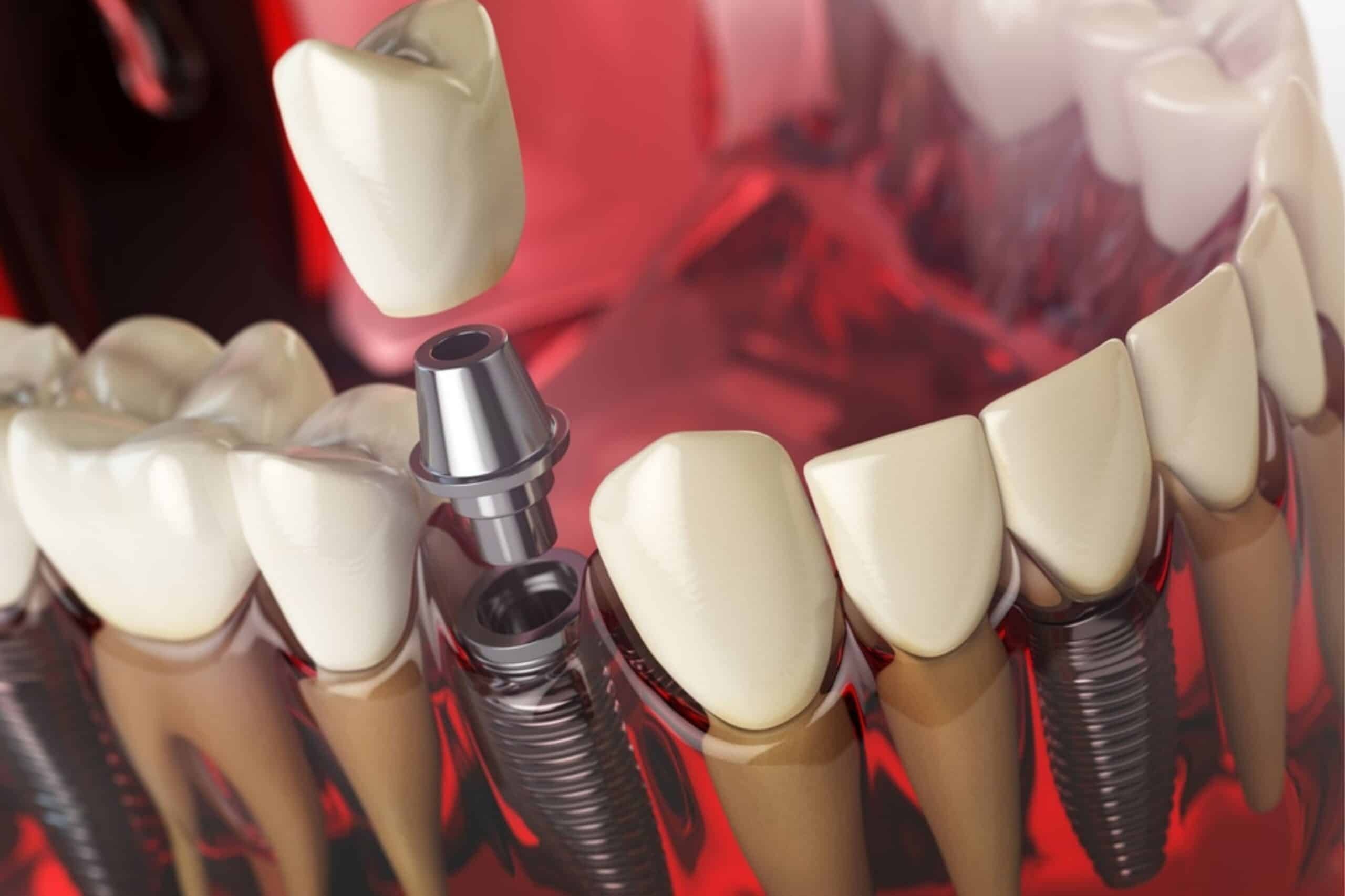 3D illustration of a dental implant procedure showing crown placement for dental implants in Paradise Valley, AZ