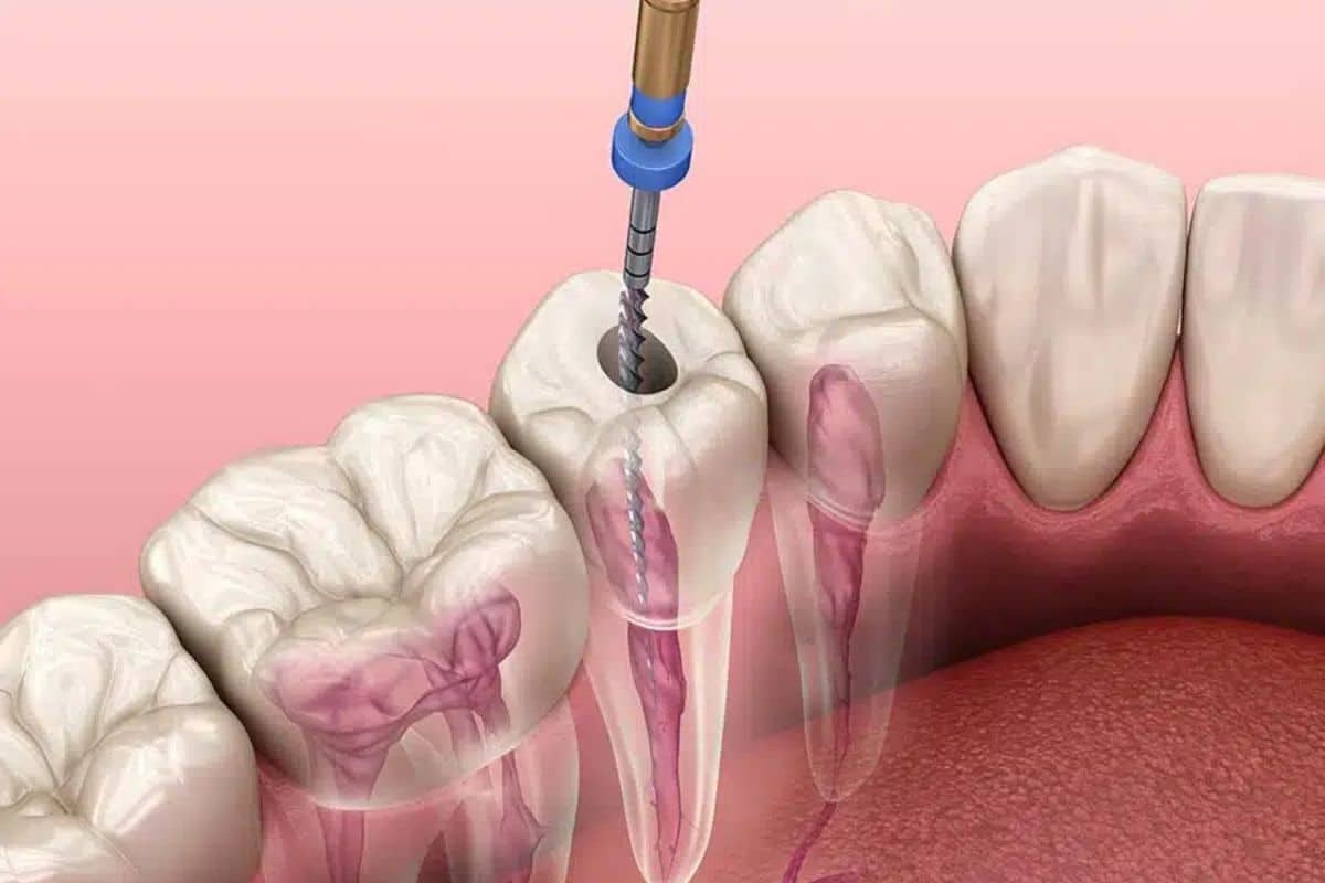 Root Canal Therapy in Paradise Valley