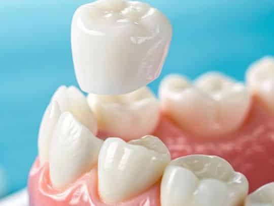 dental-crowns-paradise-valley-az