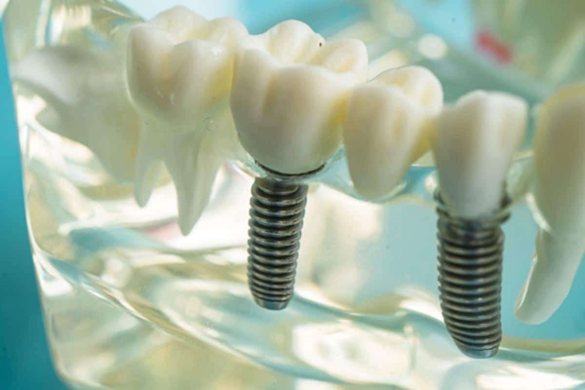 Featured image for “Can Diabetes Affect Dental Implant Success?”