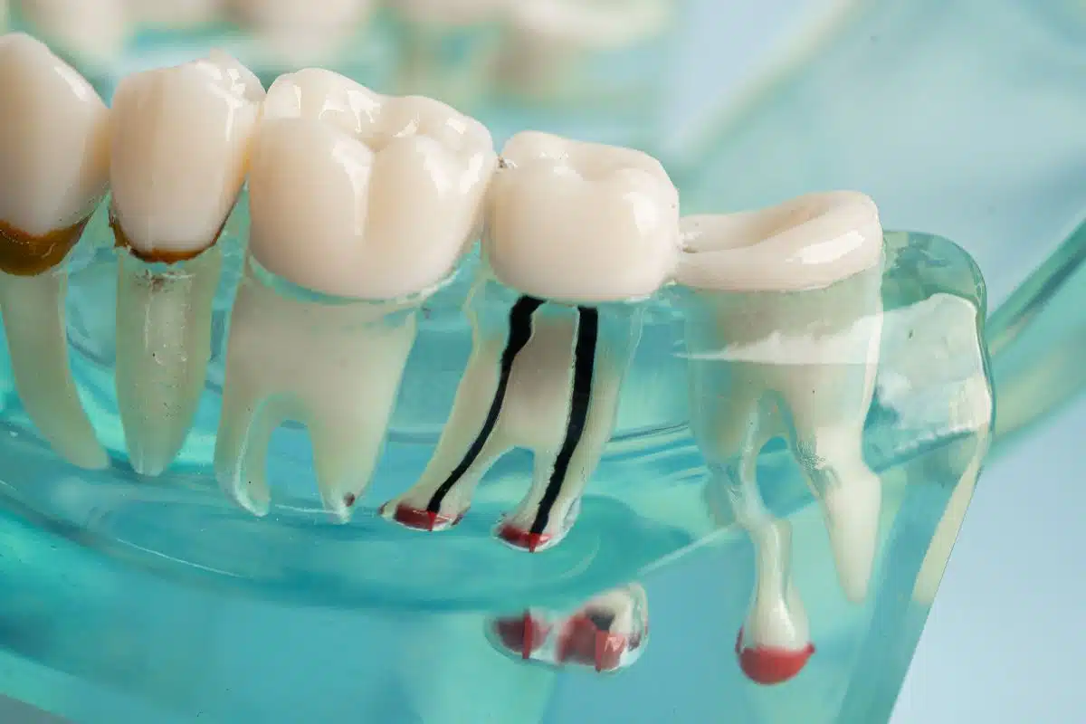 Featured image for “What Causes the Need for a Root Canal?”
