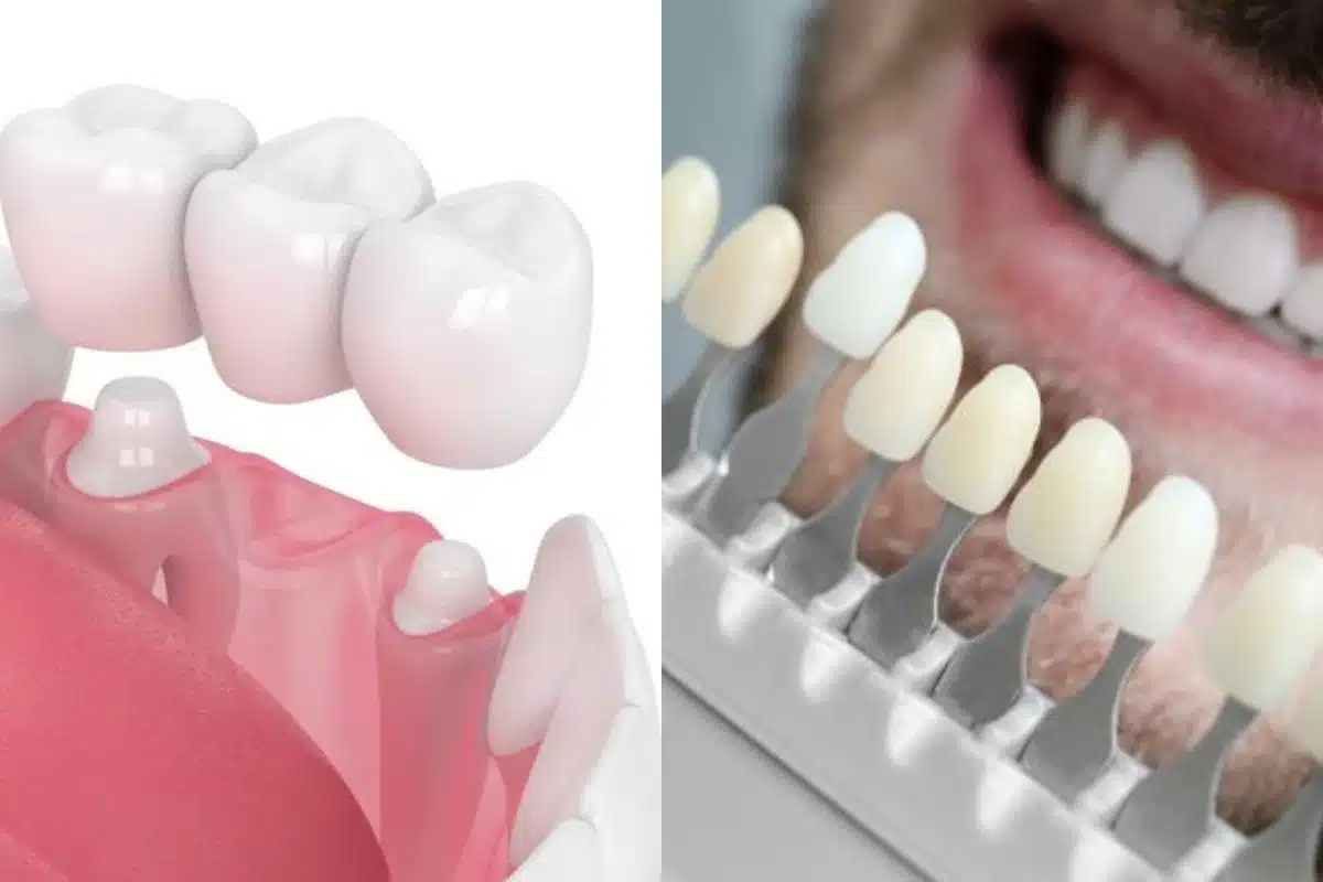 Featured image for “What Is the Difference Between Veneers and Crowns?”