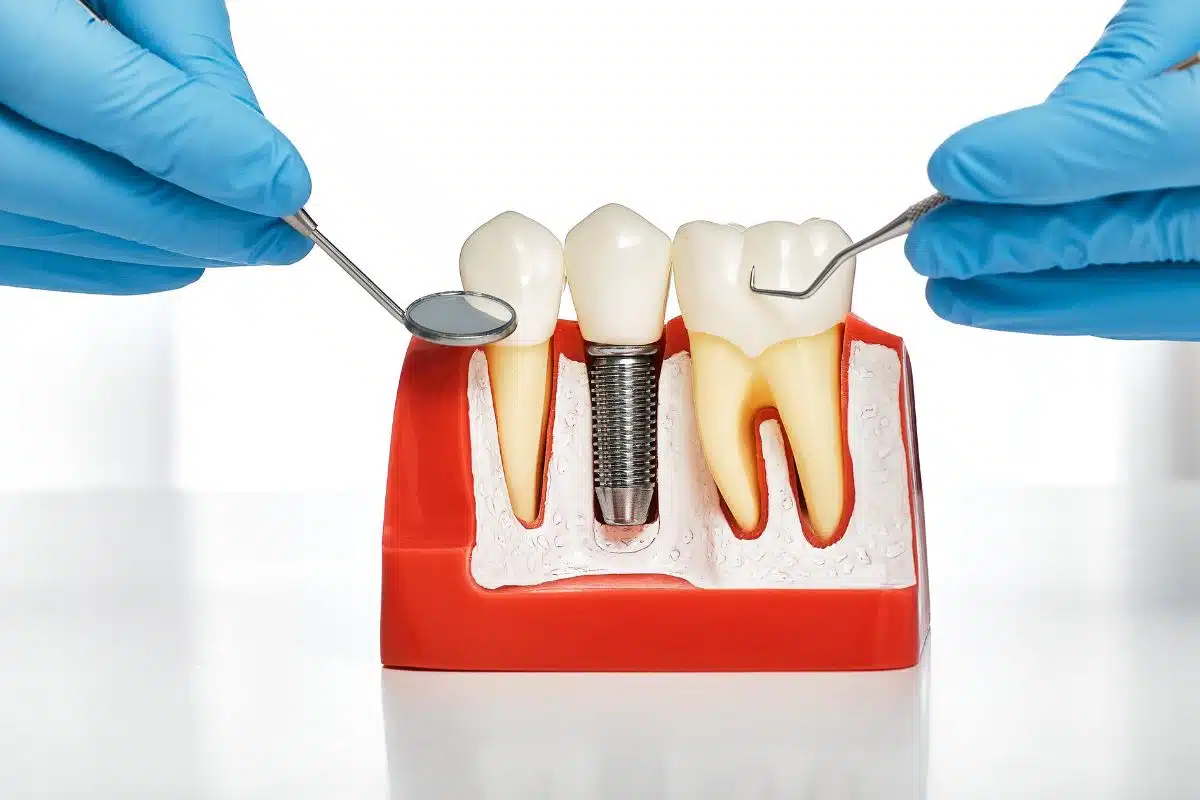 do-dental-implants-cause-sinus-problems