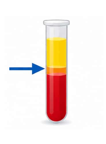 Blood is separated into a platelet rich layer